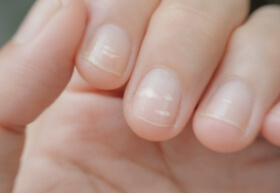 Protein Deficiency: Symptoms, Causes, and Treatments